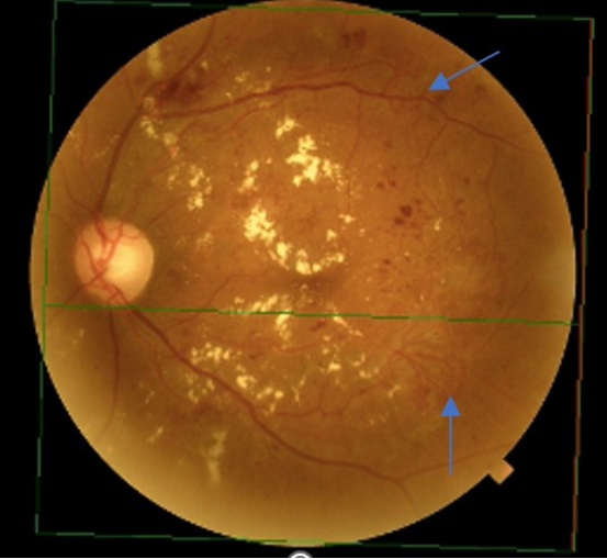 1a - retinography OS