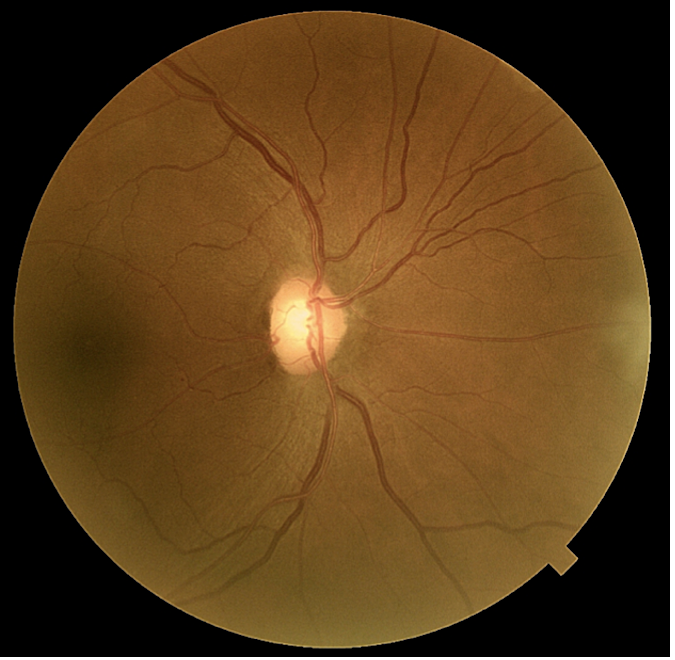 Glaucoma protocol