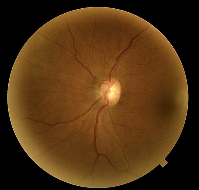 Glaucoma protocol