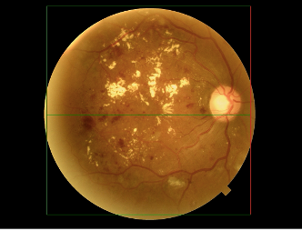 pic1b - Retina protocol