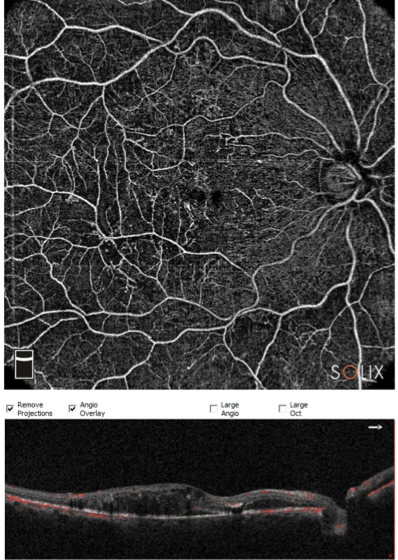 pic3 - Retina protocol