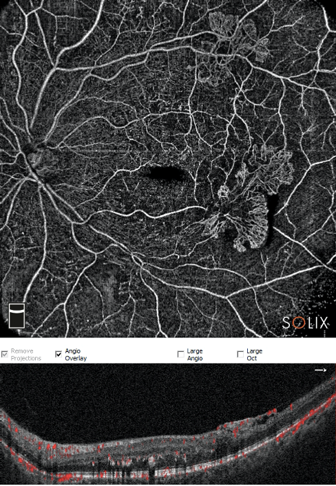 pic5 - Retina protocol